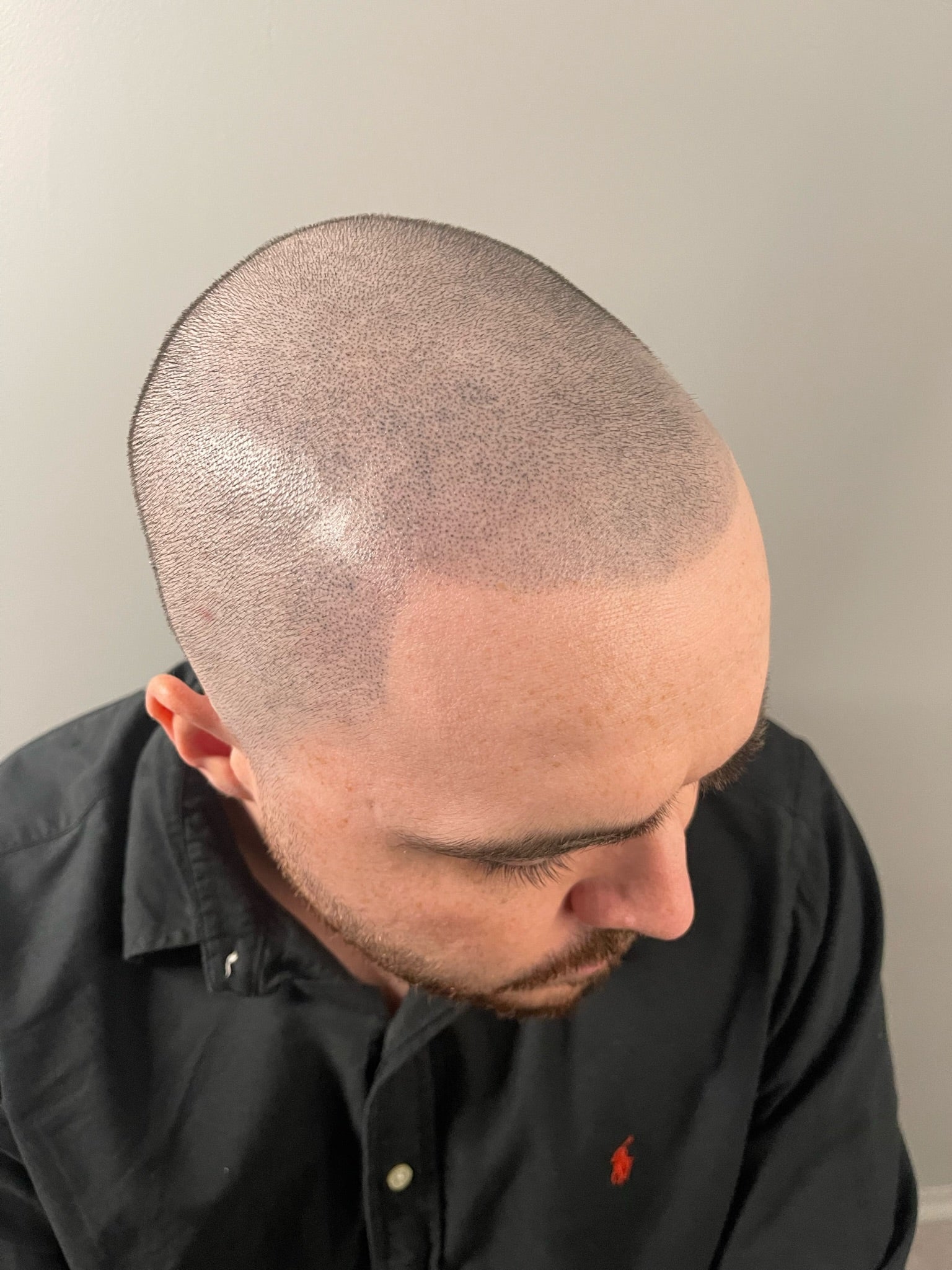 What is Scalp Micro Pigmentation | Alison Jade