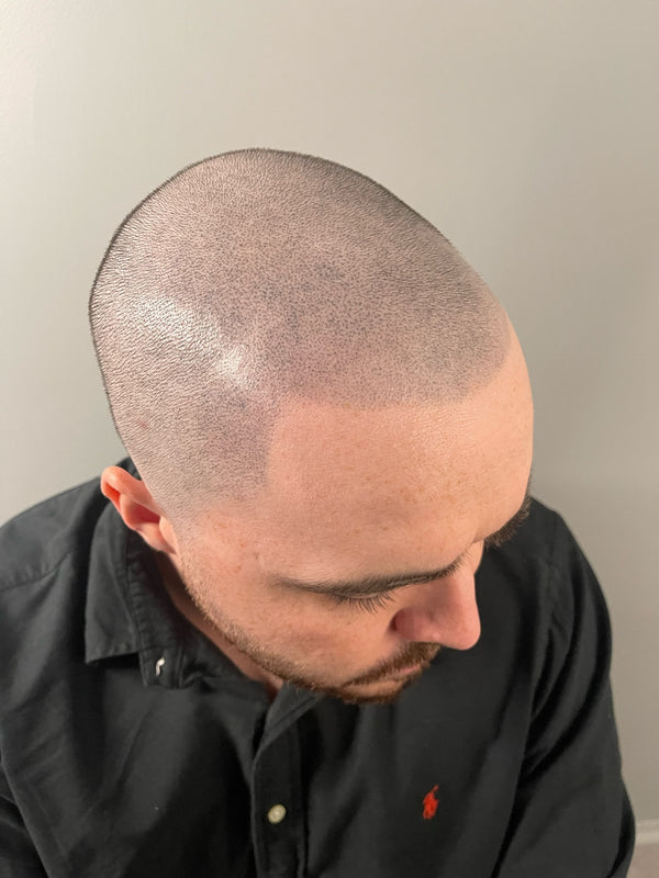 What is Scalp Micro Pigmentation | Alison Jade